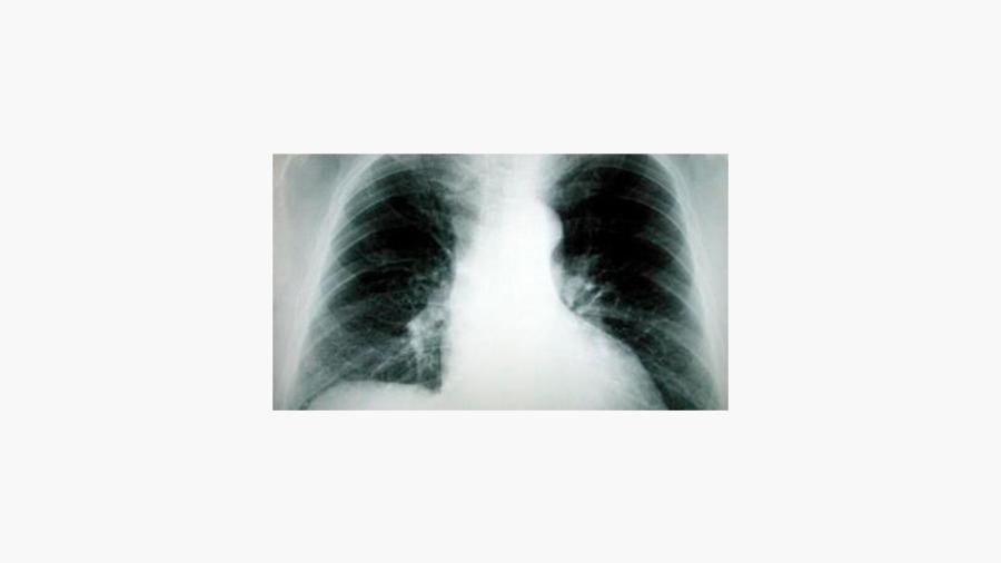 Höga radonhalter kan orsaka lungcancer (bild från Strålsäkerhetsmyndigheten).